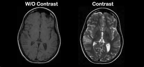 the villages mri with contrast